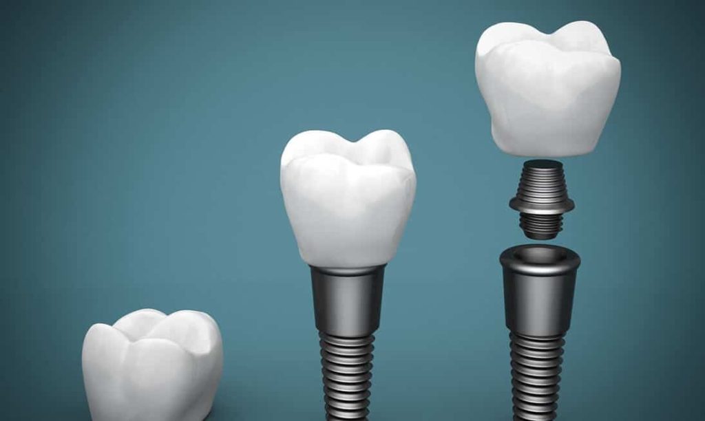 Implantate Gegenanzeigen Voraussetzungen