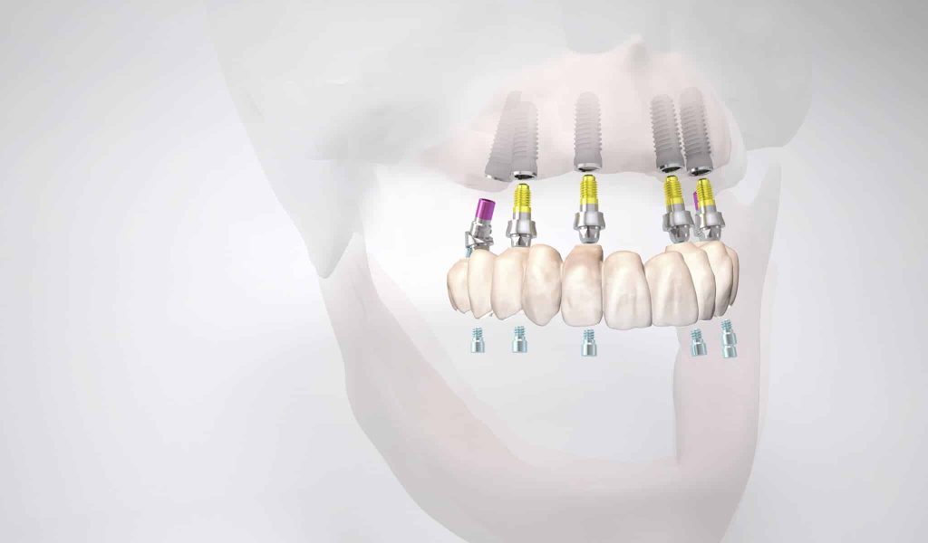 all on six bei zahnlosem Oberkiefer.