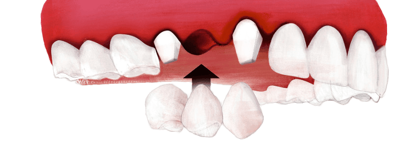 feste Brücke auf Zahnkronen