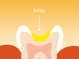 inlay