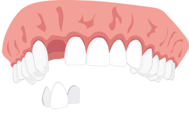 Marylandbrücke Klebebrücke