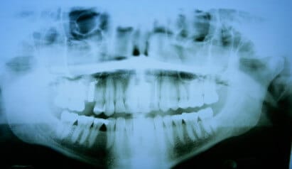 3d Röntgenbild zur Diagnose von CMD