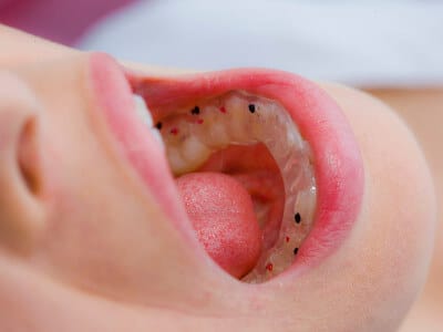 Farbmarkierungen für CMD-Aufbissschiene