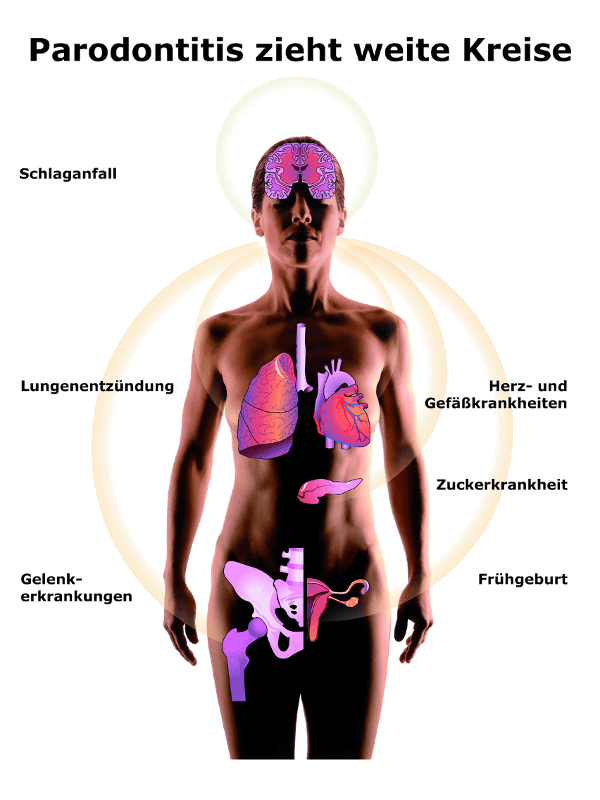 parodontose folgeerkrankungen