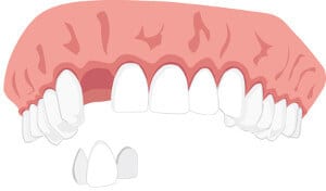 adhäsion klebebrücke adhäsivbrücke
