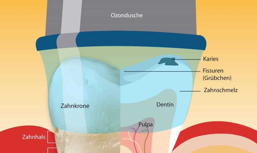 Ozontherapie Zahnmedizin