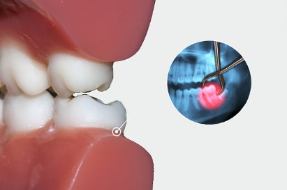 weisheitszahnentfernung