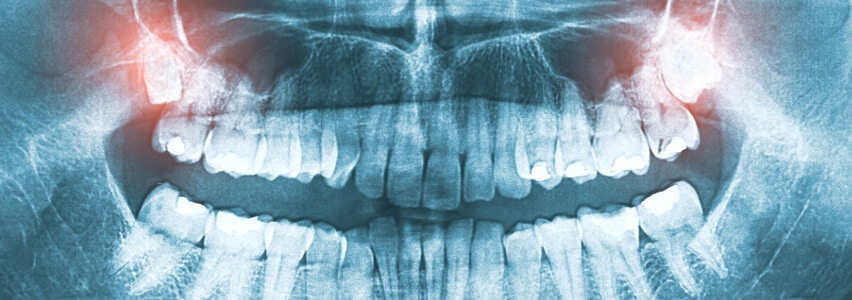 Retinierte Weisheitszähne im Oberkiefer - Röntgenbild