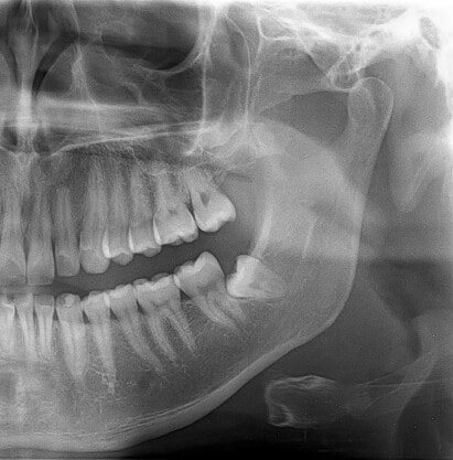 Röntgenbild eines retinierter Weisheitszahns