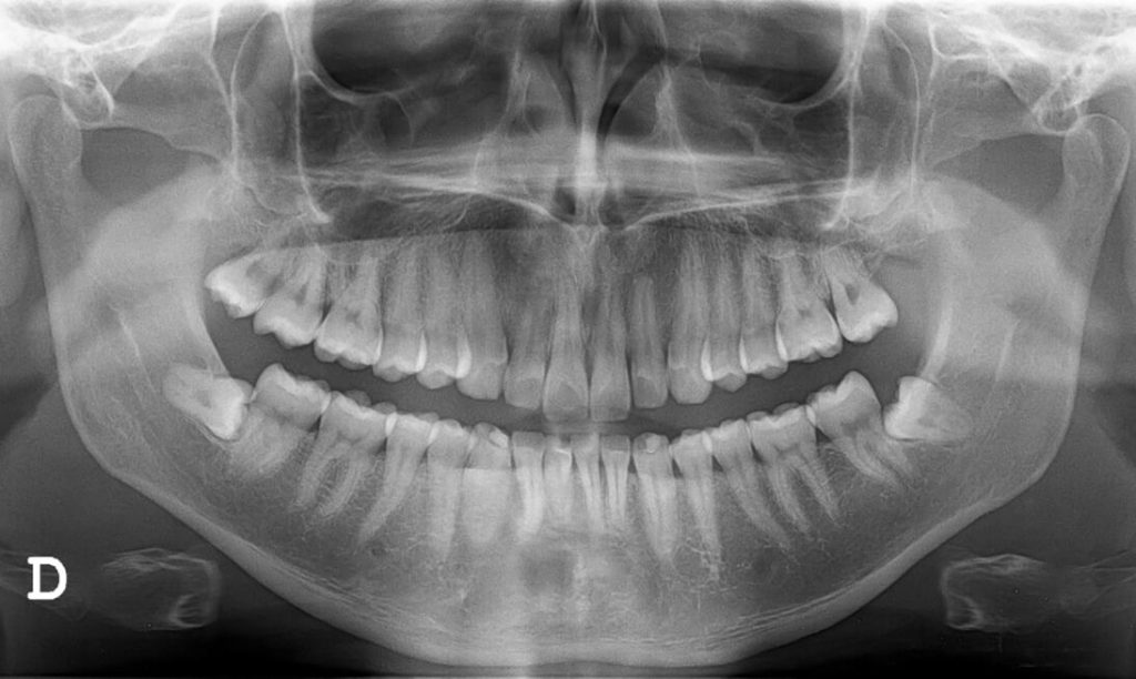 zahnfreilegung retinierte zähne