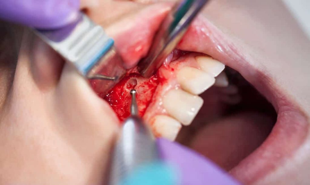 zyste entfernen zahn zahnfleisch kiefer