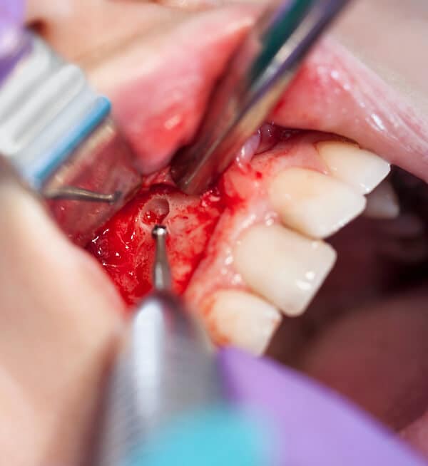 zyste im oberkiefer entfernen