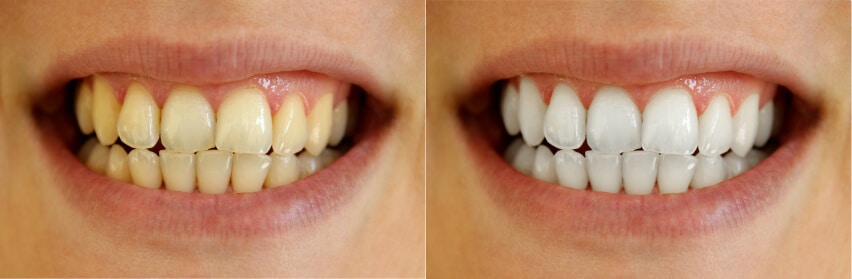 bleaching vorher nachher