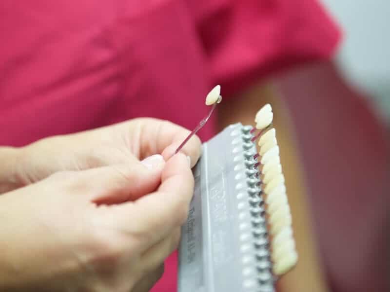 Auswahl von Lumineers mit passender Färbung in der Zahnärztlichen Praxisklinik in Herne