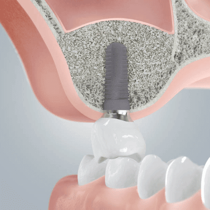 Fehlende Backenzähne im Oberkiefer 3 backenzahn oberkiefer sinuslift implantat