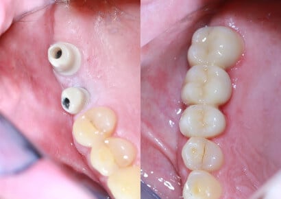 Fehlende Backenzähne im Oberkiefer 2 fehlende backenzaehne oberkiefer implantate vorher nachher