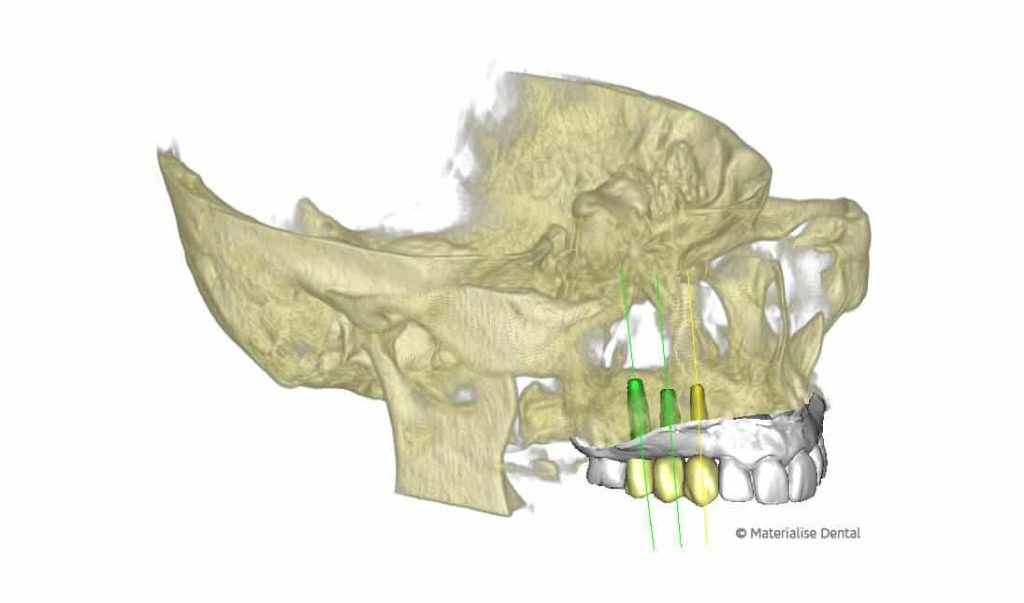 Fehlende Backenzähne im Oberkiefer 1 fehlende backenzähne oberkiefer implantologie