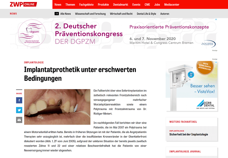 ZWP: Implantatprothetik unter erschwerten Bedingungen