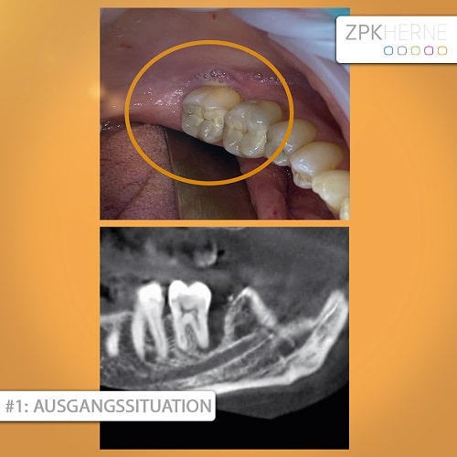 Ausgangssituation Patientenbeispiel für Sofortversorgung