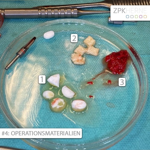 Operationsmaterialien einer Zahnimplantat Sofortversorgung