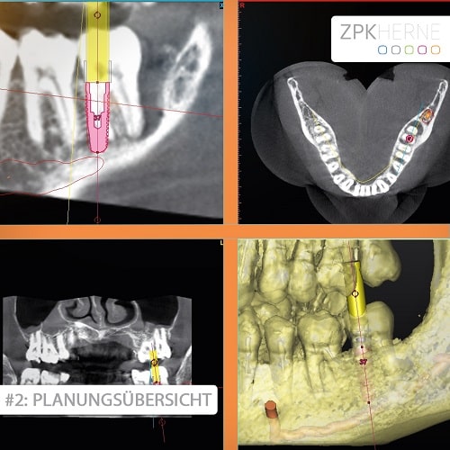 Planungsübersicht Patientenbeispiel für Sofortimplantat