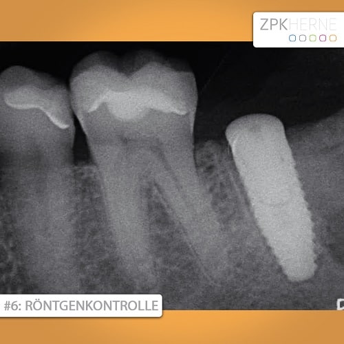 Röntgenkontrolle Sofortversorgung eines Implantats