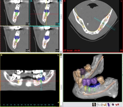 3D Planung - computernavigierter minimalinvasiver Eingriff