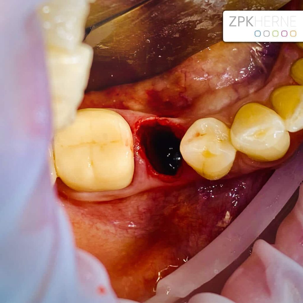 Sofortimplantat Unterkiefer - Patientenbeispiel