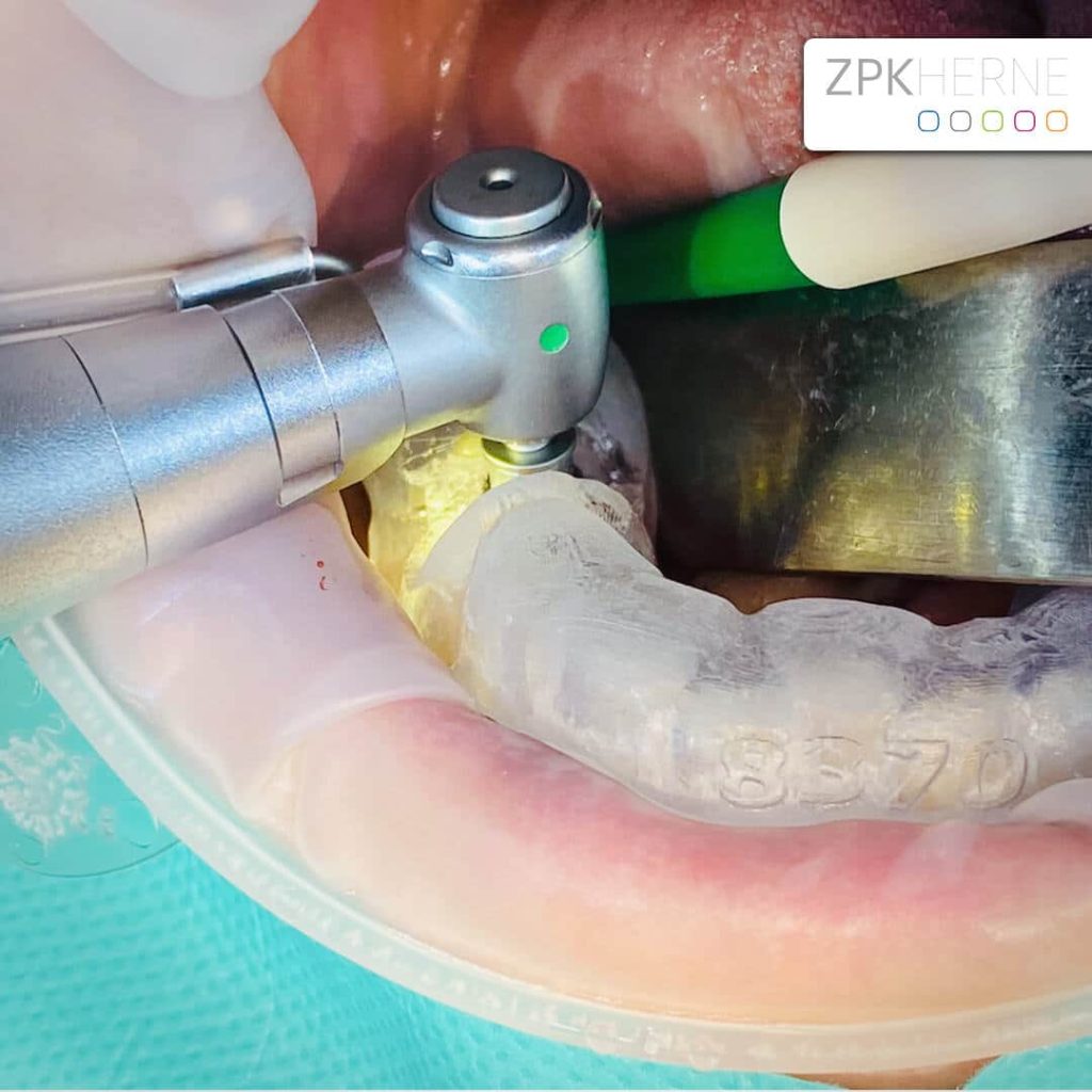 Sofortimplantation im Unterkiefer - neueste Technologien