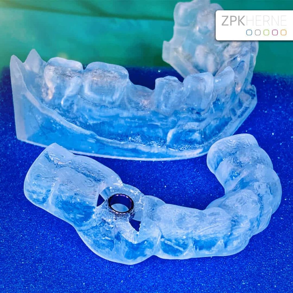 Sofortversorgung im Unterkiefer - Navigationsschiene