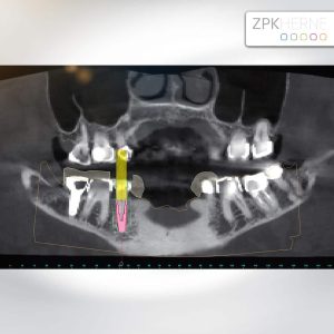 Sofortversorgung im Unterkiefer Patientenfall