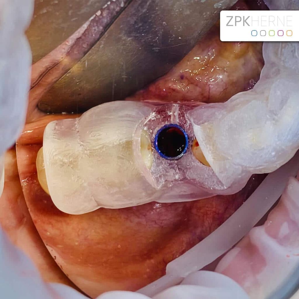 Sofortversorgung mit OP-Schiene - Patientenbeispiel