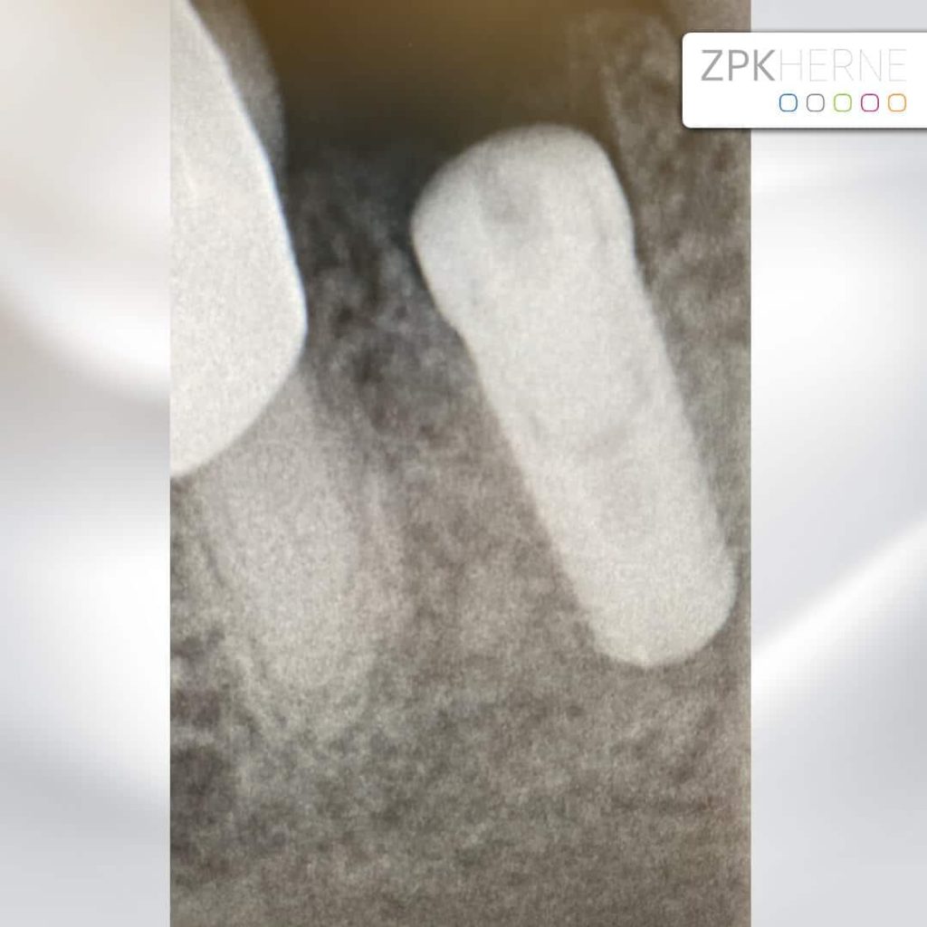 Sofortversorgung Unterkiefer - Implantat Aufnahme