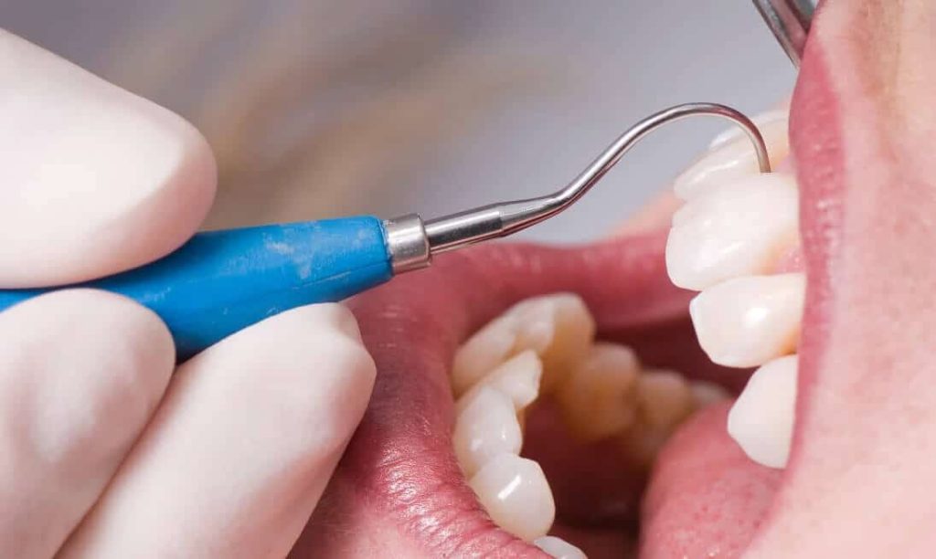 Zahnfleischentzündung Diagnose