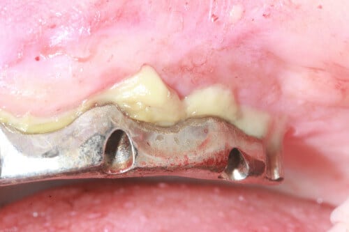 Implantatsteg im Oberkiefer mit Eiteraustritt