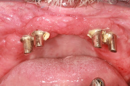 Eiteraustritt an vier Implantaten