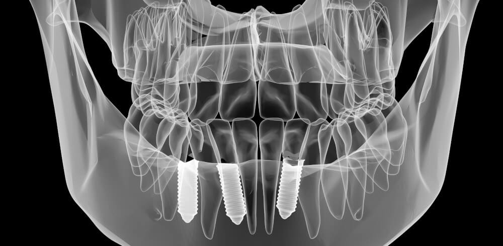 Schematische Kieferaufnahme mit Zahnimplantaten