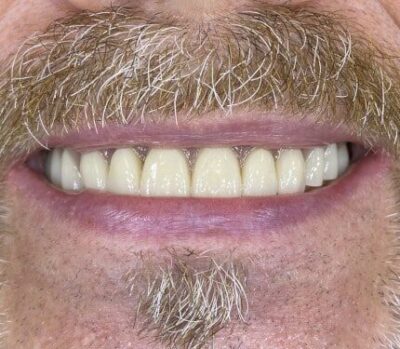 Oberkiefer-Zahnreihe nach erfolgreicher Implantatversorgung mittels All-on-Four