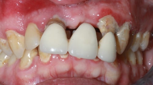 Oberkiefer mit gelockerter Brücke