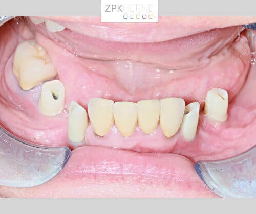 Unterkieferzahnreihe mit vier sichtbaren Implantataufbauten