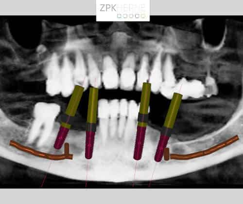 DVT-Diagnostik zur Planung von Implantation und Bohrschablone