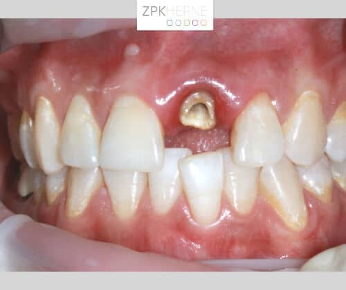 Kieferansicht mit ausgefallener Krone - Zahn 21