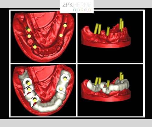 Implantatplanung im Unterkiefer mittels Simplant Software