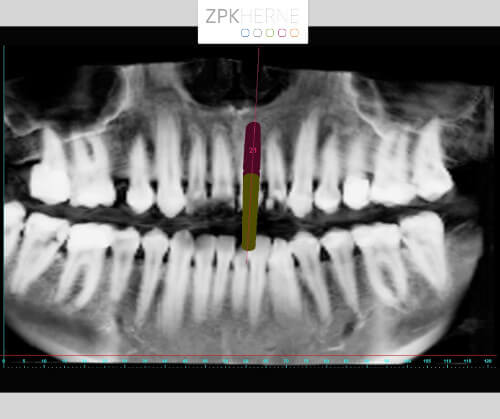 Implantatplanung mittels Simplant