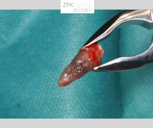 Gezogener Zahn - Detailansicht