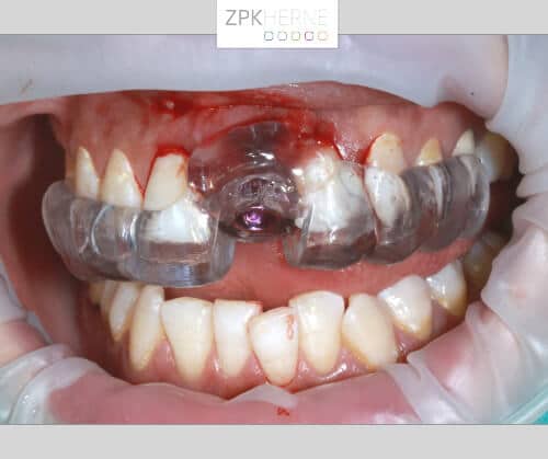 Kieferansicht mit befestigter Bohrschablone im Oberkiefer