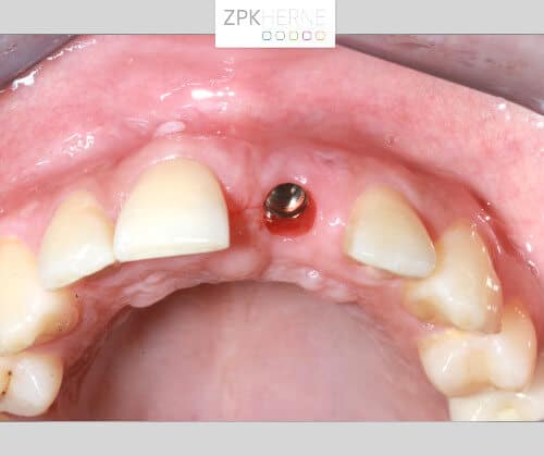Oberkiefer mit eingeheiltem Implantatkörper