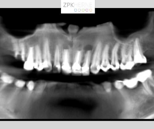 Digitale Volumentomografie mit gekürzten Wurzelspitzen
