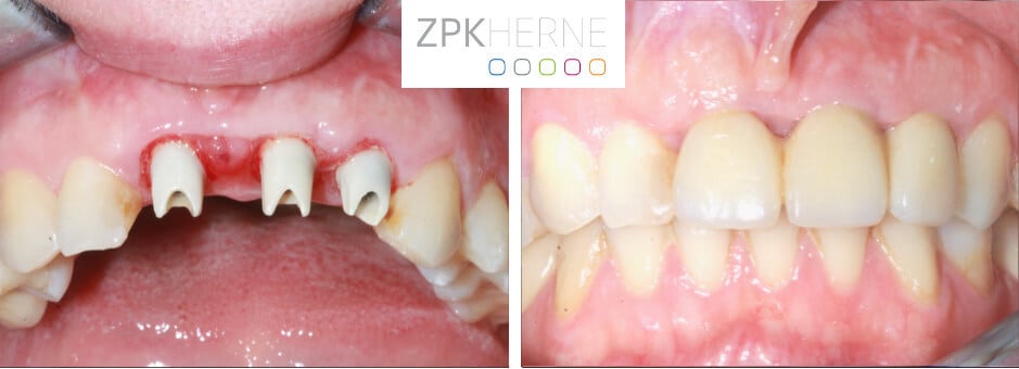 Implantataufbauten und bleibende Keramikbrücke im Oberkiefer im Frontzahnbereich 11,21,22