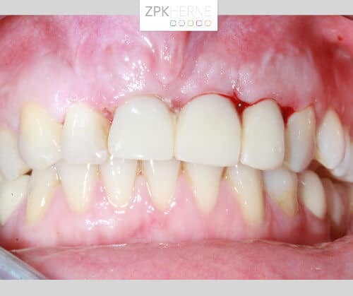 Provisorische Sofortversorgung Frontzähne 11,21,22